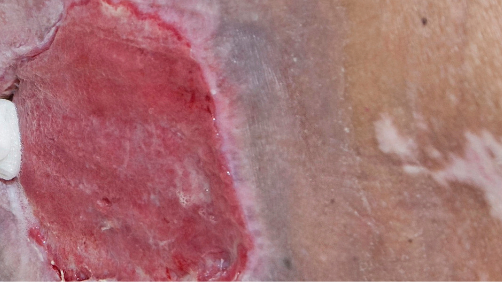 Preventing Pressure Injuries