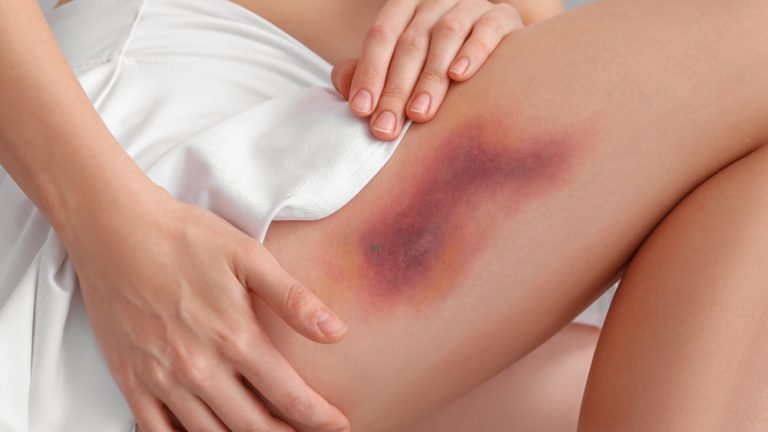 Pressure Injuries