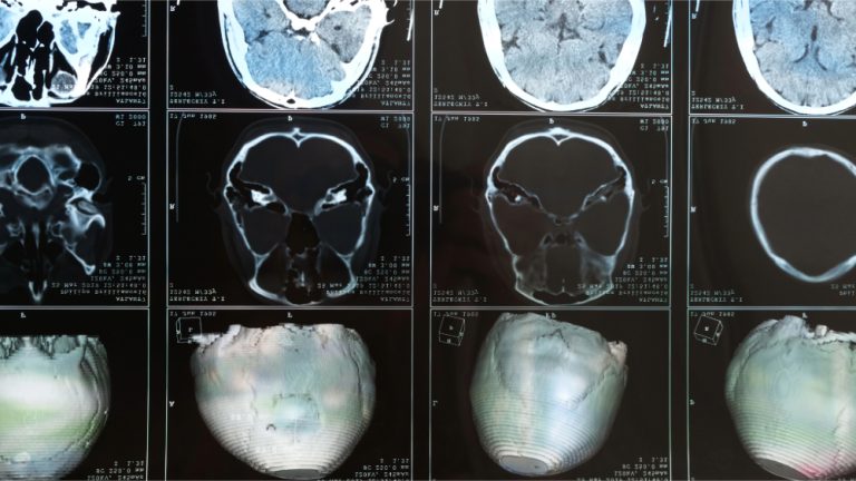 Traumatic Brain Injury