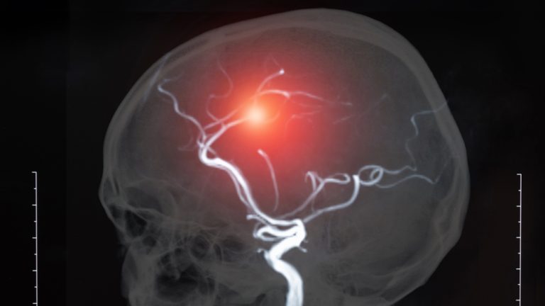 Conditions-3-Cerebral Vascular Accident (Stroke)