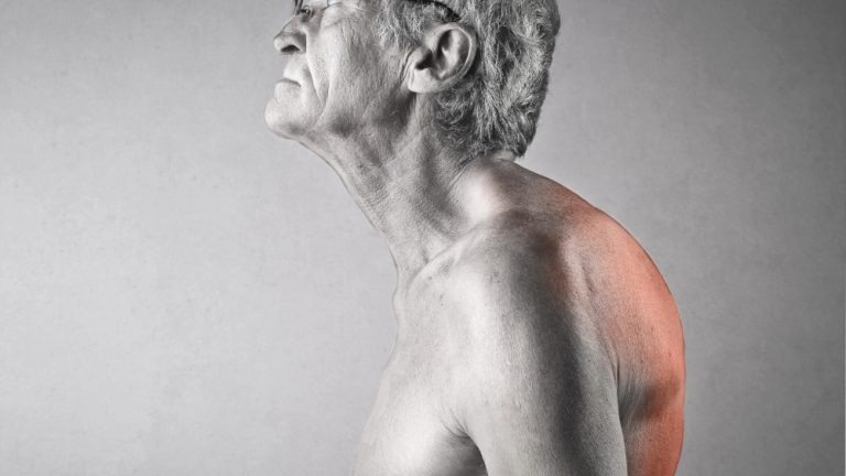 Kyphosis