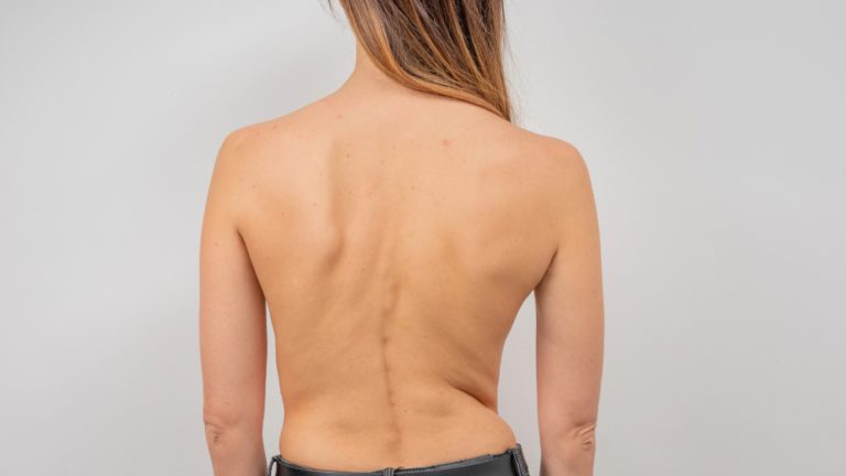 Scoliosis
